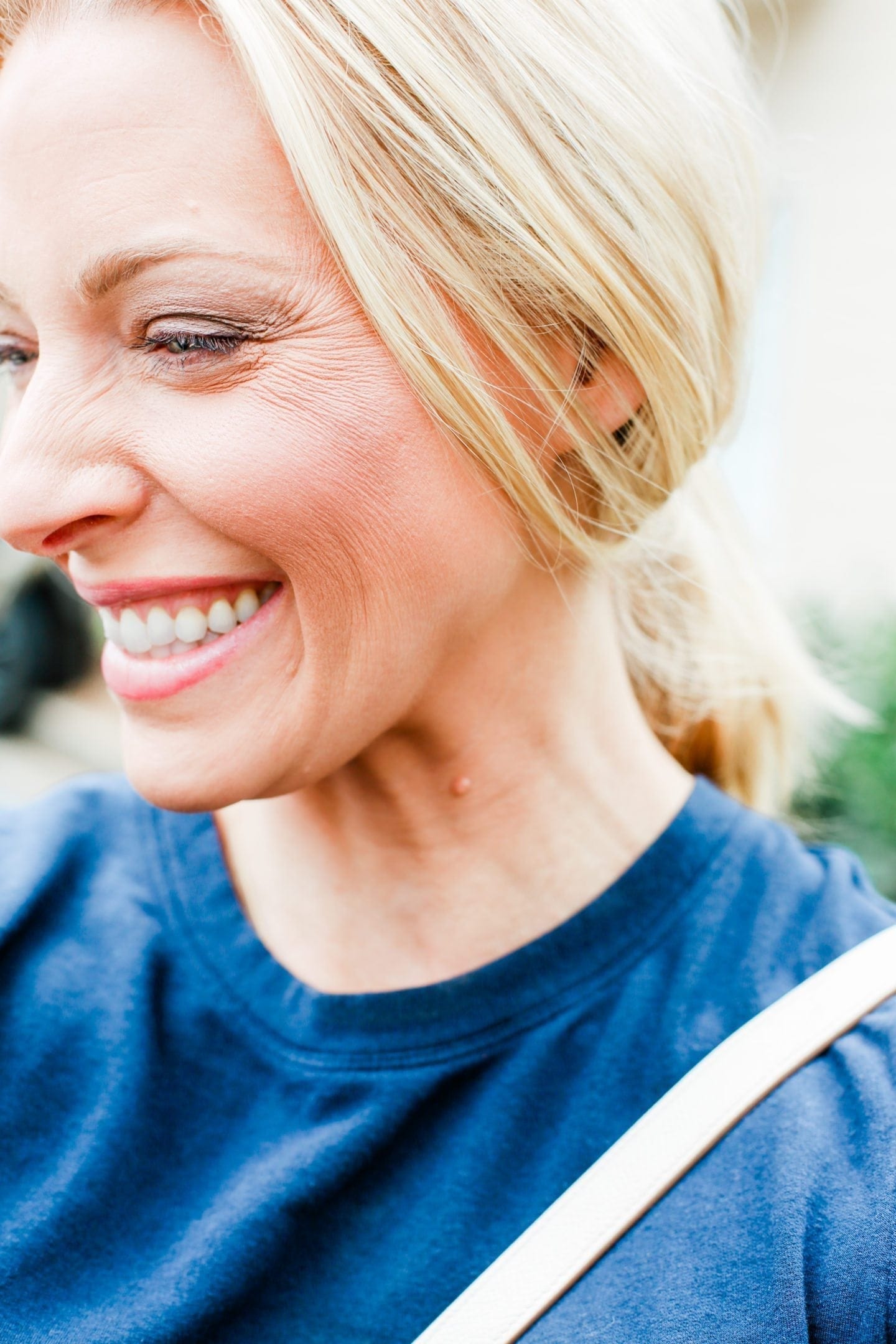 Does botox work? Before and after pictures of Botox and filler injections.