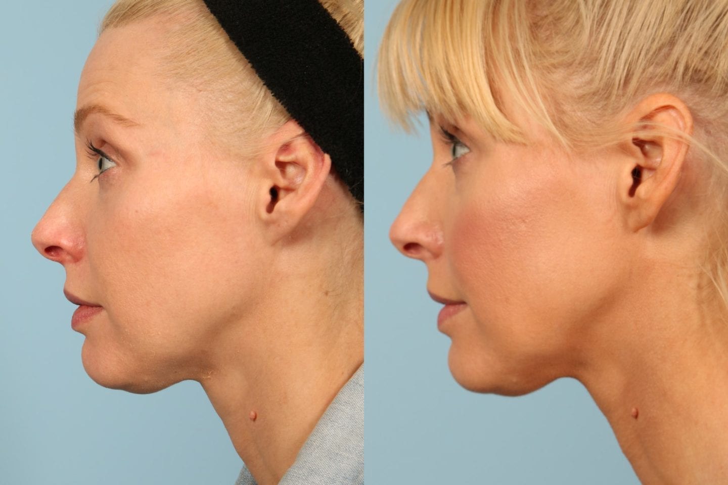 Kybella Review - my personal results