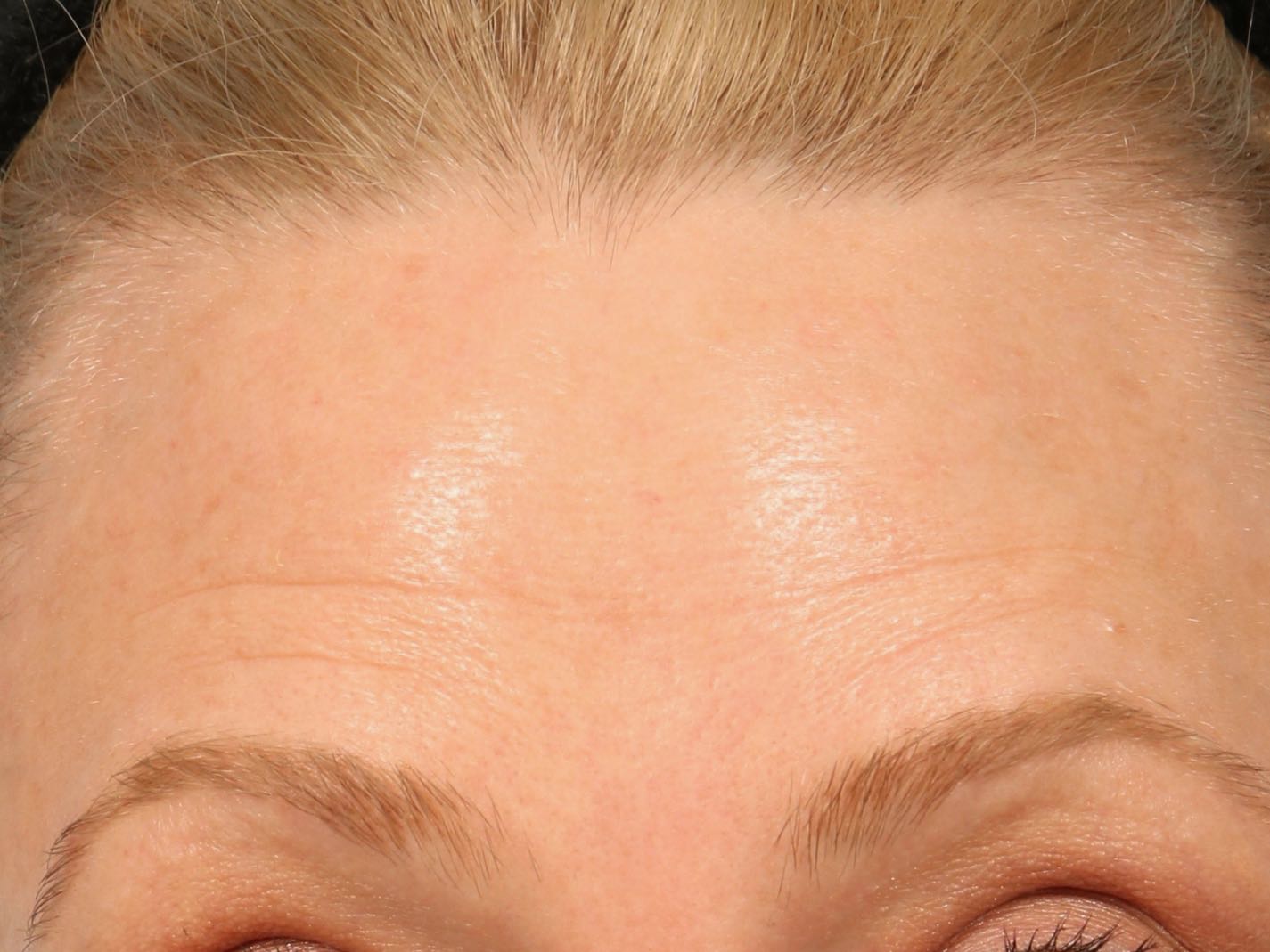 skinmedica before and after pictures