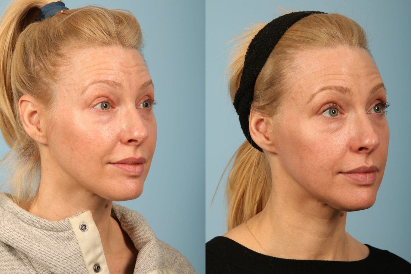 skinmedica tns essential serum before and after photos